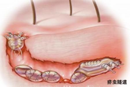 疥疮最好的治疗方法是什么呀?疥疮最好的治疗方法和用什么药最好-第1张图片-