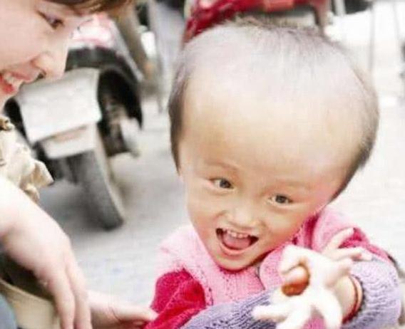 11年前因喝三鹿奶粉,变成的“大头娃娃”,如今他们都被毁了!