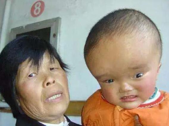 11年前因喝三鹿奶粉,变成的“大头娃娃”,如今他们都被毁了!