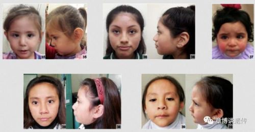 特纳综合征治疗最理想的结果(特纳综合征治疗最好的医院)-第1张图片-