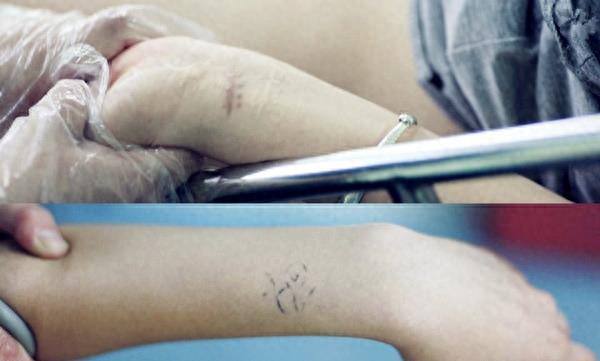 实拍人流手术全过程