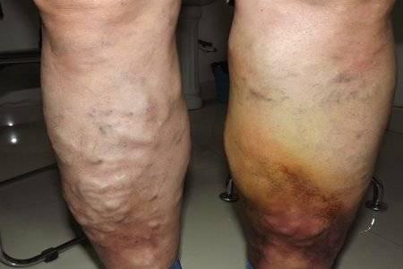 静脉曲张有什么方法治疗吗(静脉曲张怎么治疗)(1)